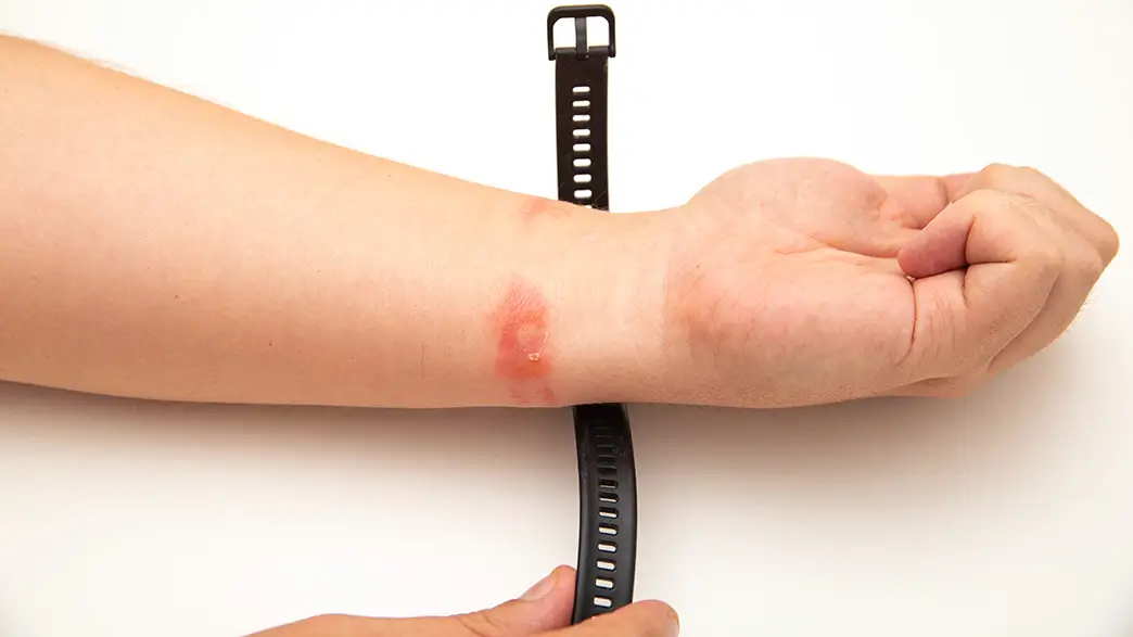 Oft zeigen die Symptome exakt, wo der Allergieauslöser gesessen hat – zum Beispiel in Form von Weichmachern in Kunststoffarmbändern Ringförmiges Kontaktekzem und Ausschlag am Handgelenk eines Mannes mit Kontaktallergie nach Tragen eines Kunststoff-Armbands