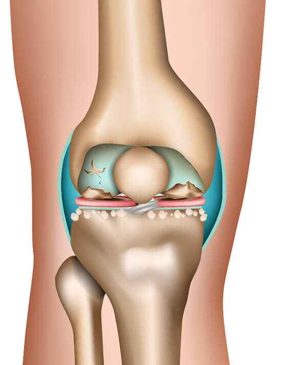 Am Beispiel der Gonarthrose lässt sich erkennen, wie die Arthrose im Verlauf mehrerer Stadien Gelenk und Knochen zusehends zersetzt Die Stadien der Arthrose am Beispiel des Kniegelenks (4. Phase)