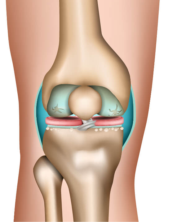 Am Beispiel der Gonarthrose lässt sich erkennen, wie die Arthrose im Verlauf mehrerer Stadien Gelenk und Knochen zusehends zersetzt Die Stadien der Arthrose am Beispiel des Kniegelenks (3. Phase)
