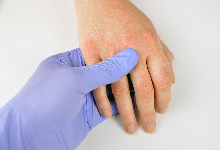 Ein Arzt trägt Nitril Handschuhe und untersucht die Hand eines Patienten