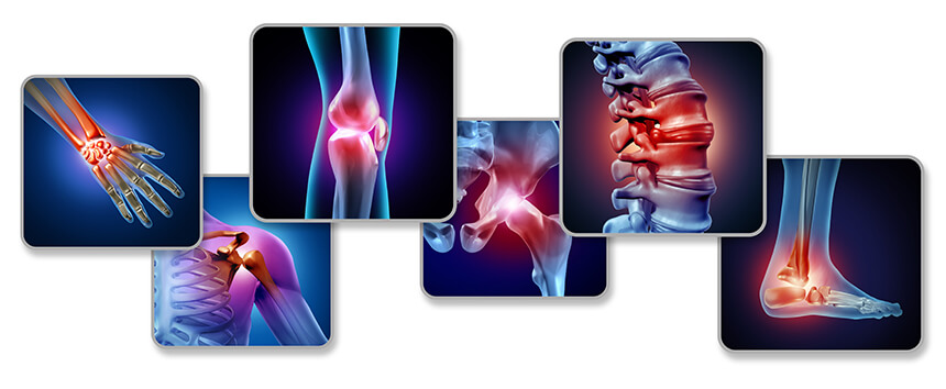 Es gibt verschiedene Arten von Arthrose Die Arthrose kann praktisch alle Gelenke des Körpers betreffen