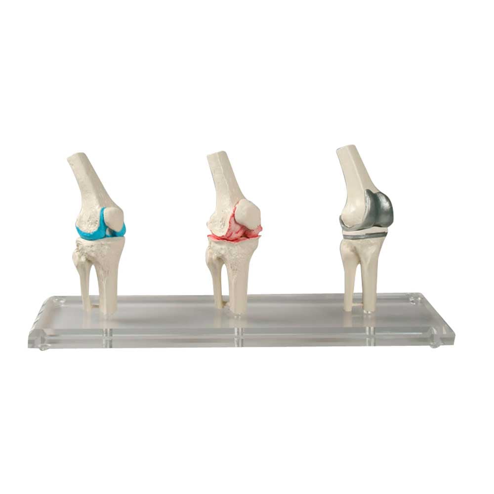 Erler Zimmer Knie-Implantat-Modell, 3 Stck, gesund/erkrankt/Implantat