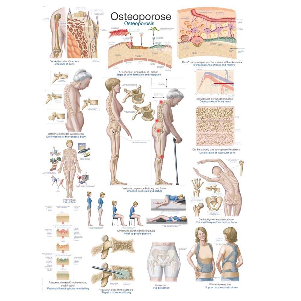 Erler Zimmer anatomische Lehrtafel „Osteoporose“, versch. Größen