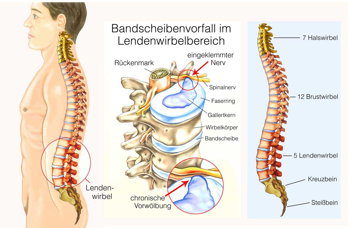 Auf dieser Grafik ist zu sehen, wie der austretende Gallertkern der Bandscheibe auf die Nerven drückt Grafik austretende Gallertkern der Bandscheibe auf die Nerven drückt