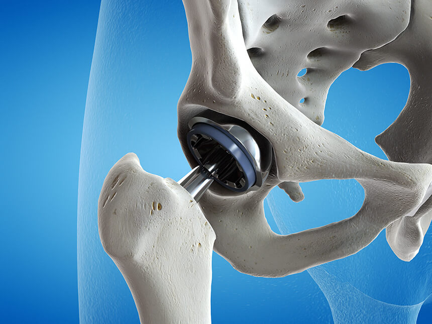 Bei stark vorangeschrittener Arthrose kann eine Operation aushelfen Grafische Darstellung einer Hüftprothese wie sie bei der Coxarthrose nötig sein kann
