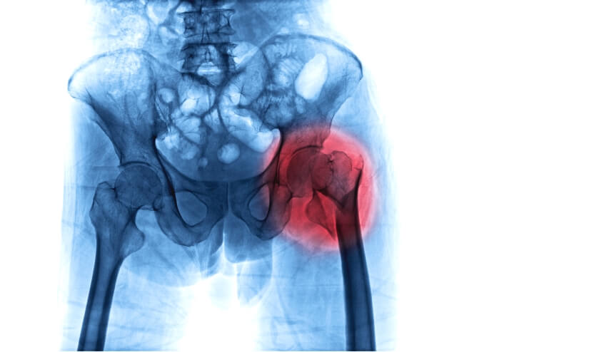 Oberschenkelhalsbruch nach Sturz im Röntgenbild