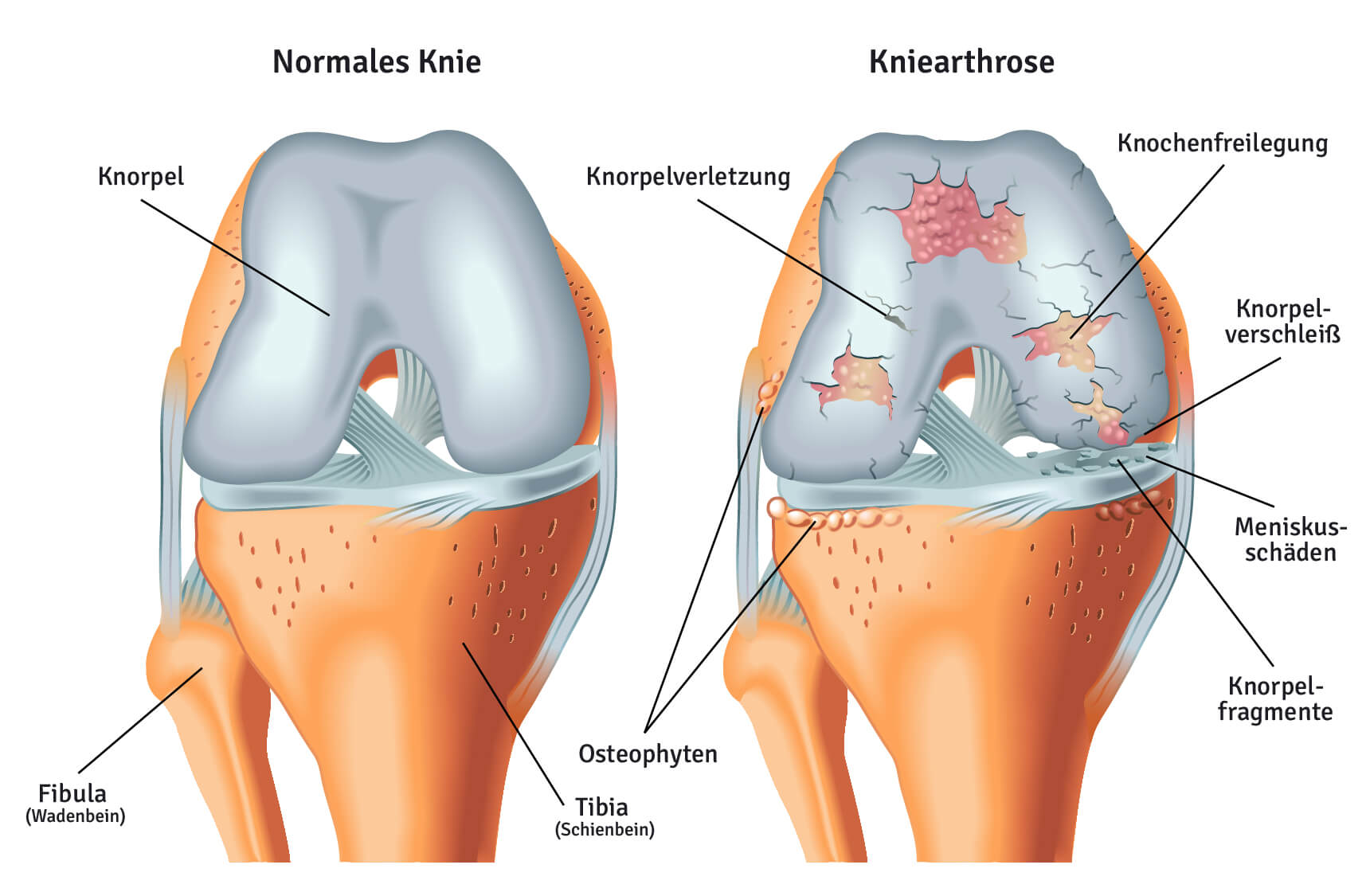 Es gibt verschiedene Arten von Arthrose Ein gesundes Kniegelenk im Vergleich zum arthritischen, stark geschädigten Knie