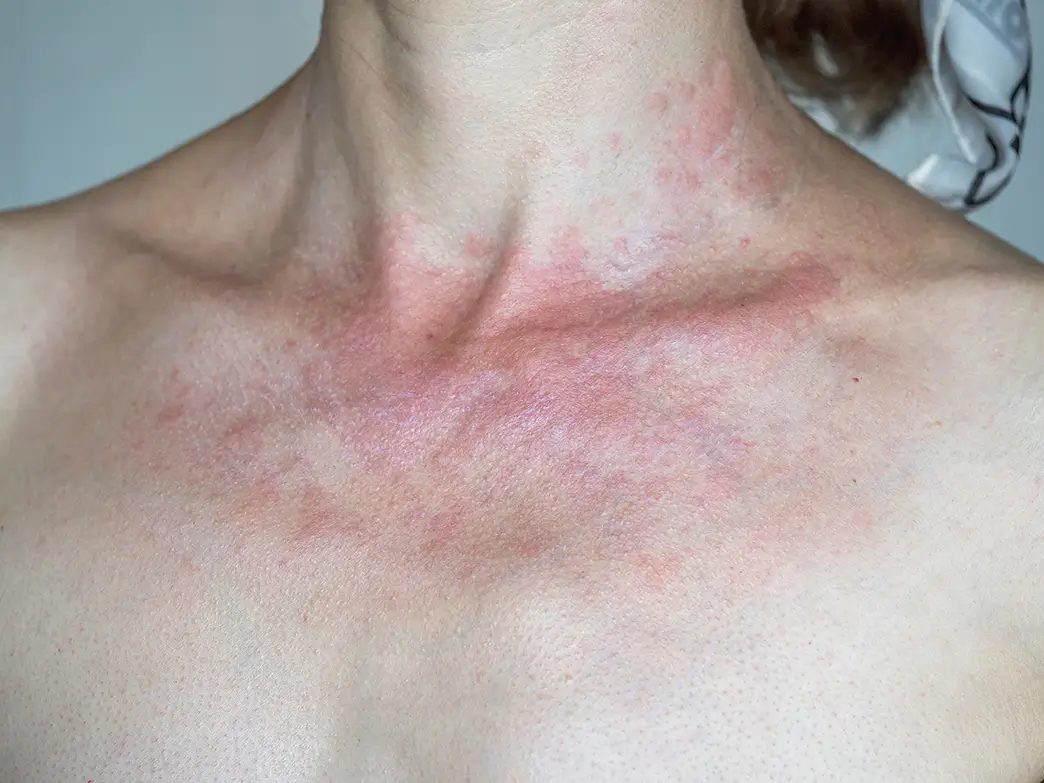 Polymorphe Lichtdermatose kann sich durch ausgeprägte Rötungen, Schwellungen, Bläschen und Pusteln bemerkbar machen Frau mit durch Sonnenallergie geröteten und geschwollenen Hautpartien im Halsbereich