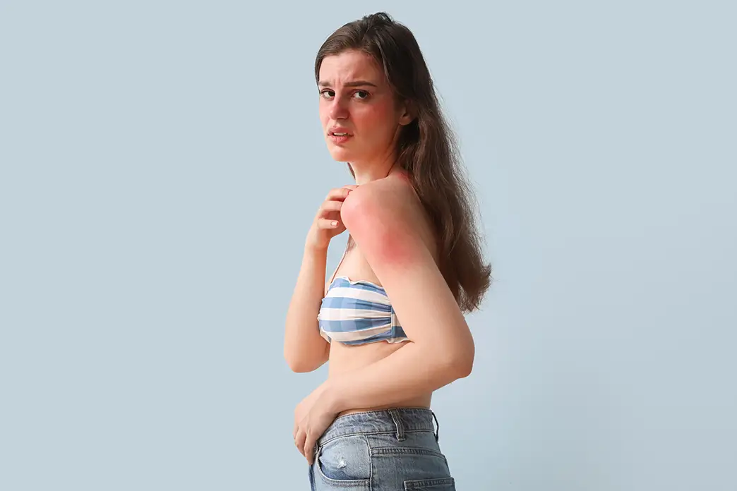 Sonnenallergie tritt oft im Frühjahr an Hautpartien auf, die längere Zeit keiner UV-Strahlung ausgesetzt waren Junge Frau mit durch Sonnenallergie geröteter Haut am Oberarm und im Gesicht