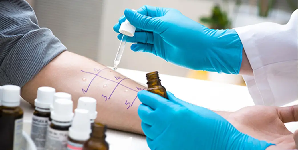Hauttests gehören zu den häufigsten Methoden, Allergien zu testen Epiktantests oder Pricktests sind übliche Verfahren, um Allergien zu testen