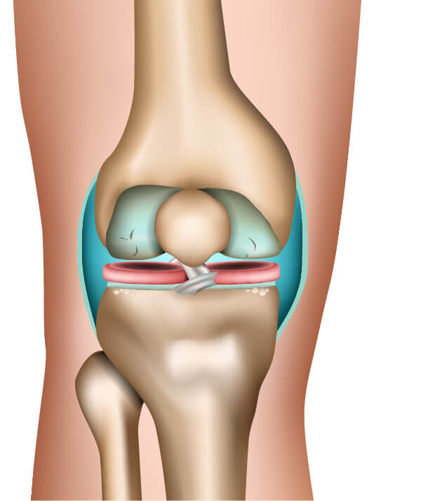 Am Beispiel der Gonarthrose lässt sich erkennen, wie die Arthrose im Verlauf mehrerer Stadien Gelenk und Knochen zusehends zersetzt Die Stadien der Arthrose am Beispiel des Kniegelenks (2. Phase)