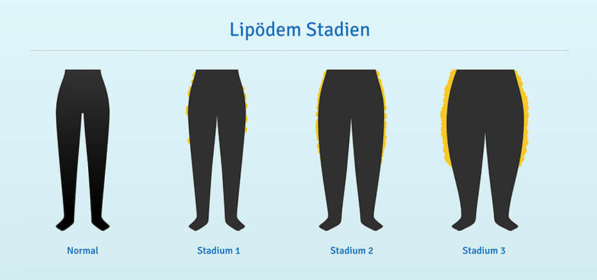 Im Laufe der drei Stadien des Lipödems nehmen die Fettablagerungen drastisch zu Fettablagerungen in den drei Stadien des Lipödems